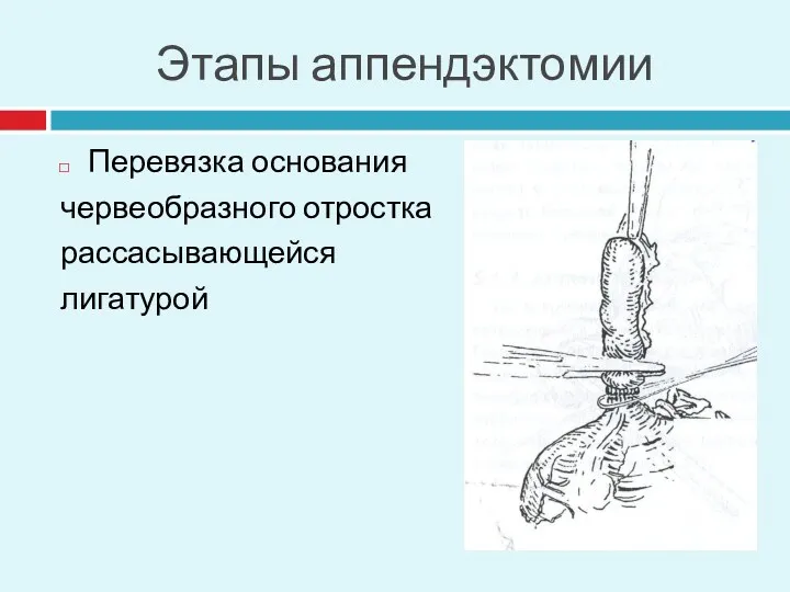 Этапы аппендэктомии Перевязка основания червеобразного отростка рассасывающейся лигатурой