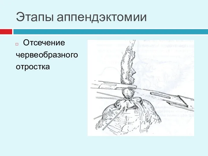 Этапы аппендэктомии Отсечение червеобразного отростка