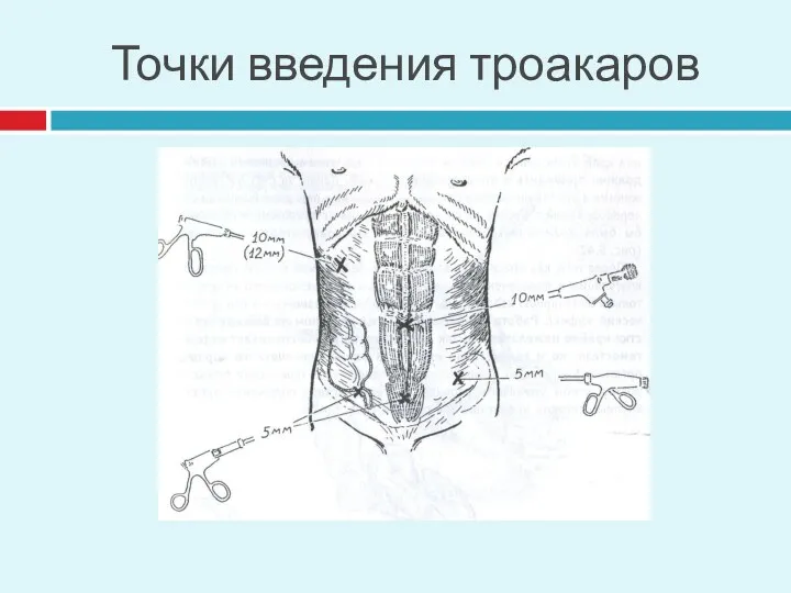 Точки введения троакаров