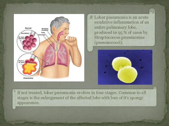 Lobar pneumonia is an acute exudative inflammation of an entire pulmonary lobe, produced
