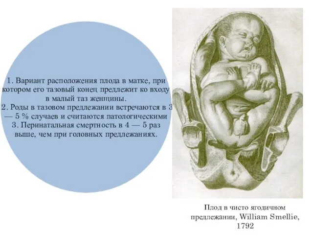 Плод в чисто ягодичном предлежании, William Smellie, 1792