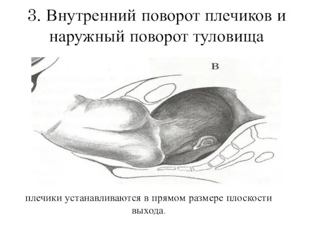 3. Внутренний поворот плечиков и наружный поворот туловища плечики устанавливаются в прямом размере плоскости выхода.