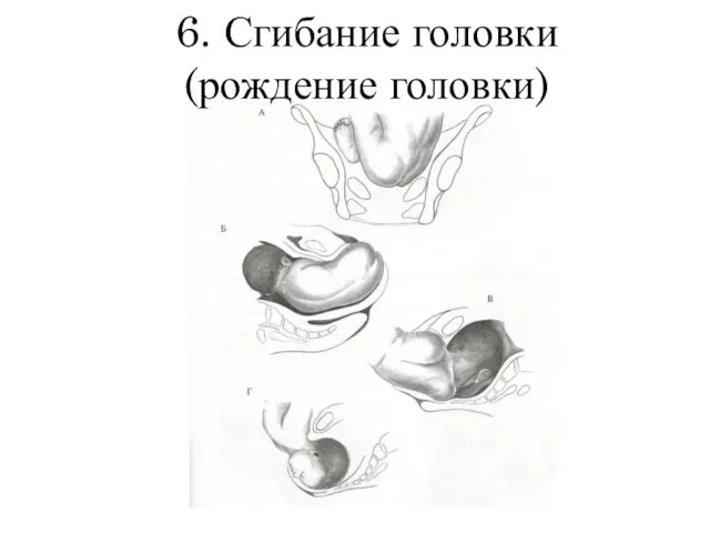 6. Сгибание головки (рождение головки)