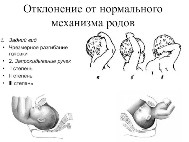 Отклонение от нормального механизма родов Задний вид Чрезмерное разгибание головки