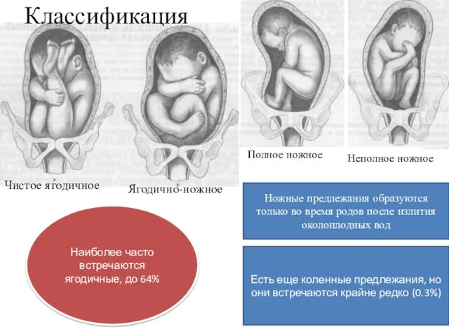 Классификация Чистое ягодичное Ягодично-ножное Полное ножное Неполное ножное Ножные предлежания