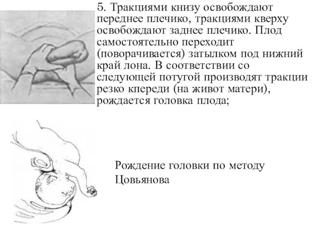 5. Тракциями книзу освобождают переднее плечико, тракциями кверху освобождают заднее