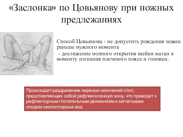 «Заслонка» по Цовьянову при ножных предлежаниях Способ Цовьянова - не