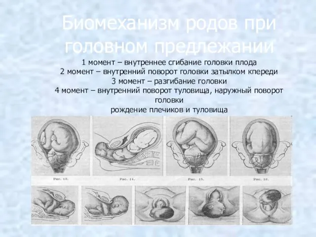 Биомеханизм родов при головном предлежании 1 момент – внутреннее сгибание