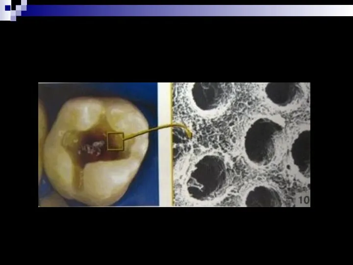 Строение дентина (электронный сканирующий микроскоп)