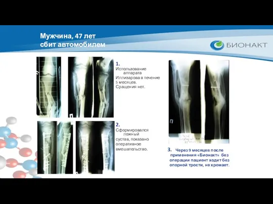 Мужчина, 47 лет сбит автомобилем Использование аппарата Иллизарова в течение 5 месяцев. Сращения