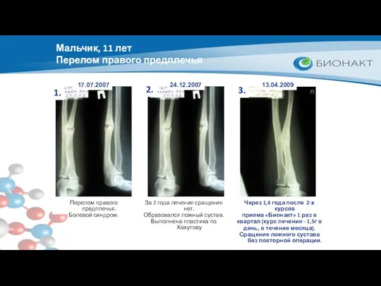 Мальчик, 11 лет Перелом правого предплечья 1. 2. 3. Перелом правого предплечья. Болевой