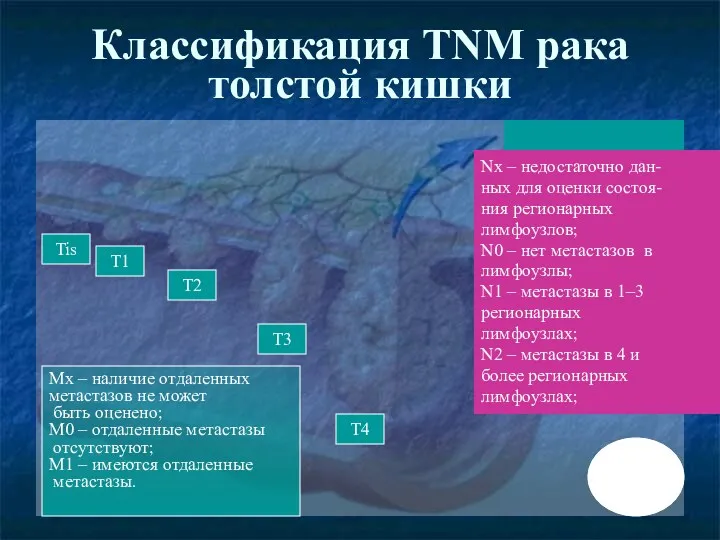 Классификация TNM рака толстой кишки Tis T1 T2 T3 T4