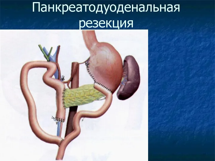 Панкреатодуоденальная резекция