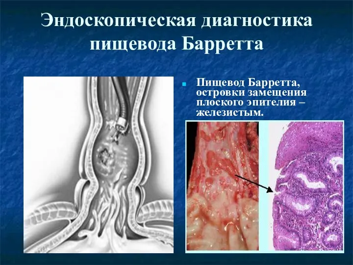 Эндоскопическая диагностика пищевода Барретта Пищевод Барретта, островки замещения плоского эпителия – железистым.