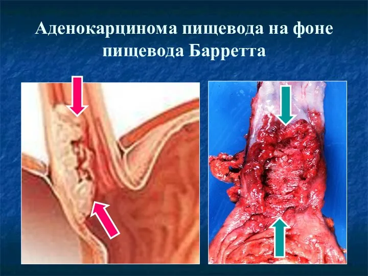 Аденокарцинома пищевода на фоне пищевода Барретта