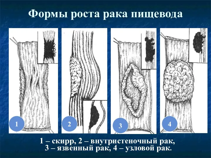 Формы роста рака пищевода 2 4 3 1 1 –