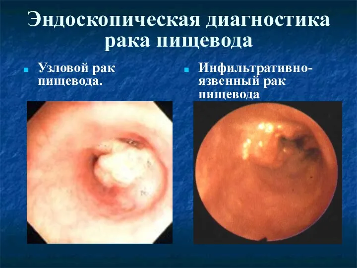 Эндоскопическая диагностика рака пищевода Узловой рак пищевода. Инфильтративно-язвенный рак пищевода