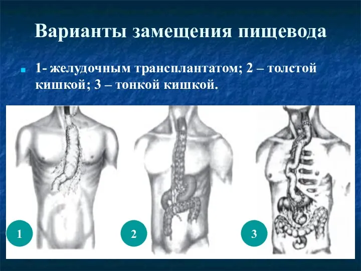 Варианты замещения пищевода 1- желудочным трансплантатом; 2 – толстой кишкой;