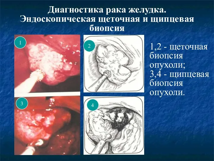 Диагностика рака желудка. Эндоскопическая щеточная и щипцевая биопсия 1 3