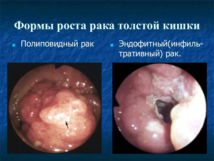 Формы роста рака толстой кишки Полиповидный рак Эндофитный(инфиль-тративный) рак.