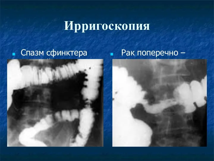 Ирригоскопия Спазм сфинктера толстой кишки Рак поперечно –ободочной кишки