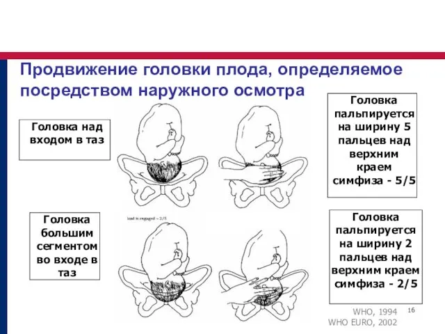 Продвижение головки плода, определяемое посредством наружного осмотра Головка над входом