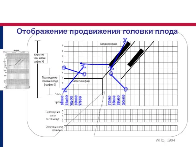 13:00 14:00 15:00 16:00 17:00 Отображение продвижения головки плода X