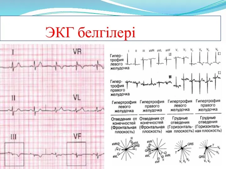 ЭКГ белгілері