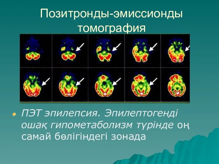 Позитронды-эмиссионды томография ПЭТ эпилепсия. Эпилептогенді ошақ гипометаболизм түрінде оң самай бөлігіндегі зонада