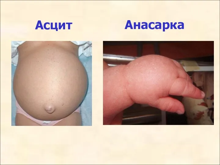 Асцит Анасарка