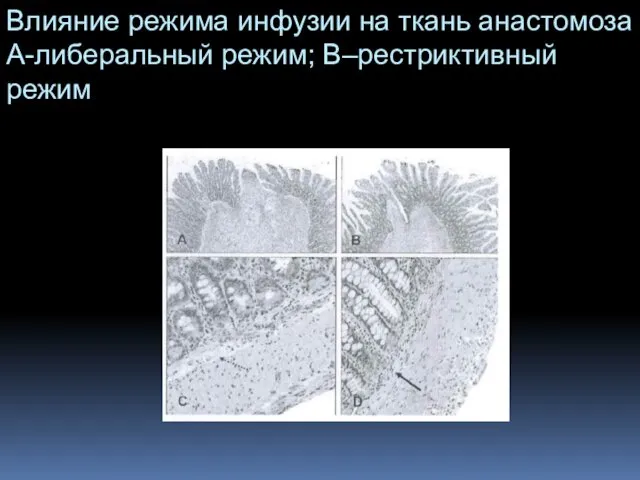 Влияние режима инфузии на ткань анастомоза А-либеральный режим; В–рестриктивный режим