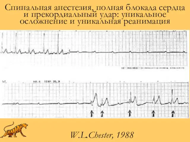 Спинальная анестезия, полная блокада сердца и прекордиальный удар: уникальное осложнение и уникальная реанимация W.L.Chester, 1988