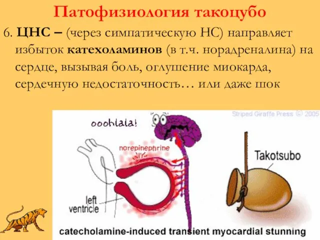 Патофизиология такоцубо 6. ЦНС – (через симпатическую НС) направляет избыток