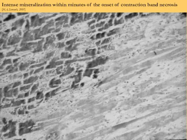 Intense mineralization within minutes of the onset of contraction band necrosis [M.A.Samuels, 2007]