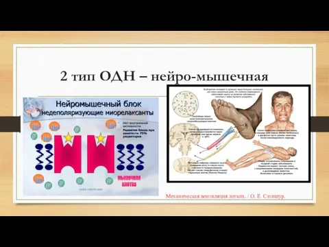 2 тип ОДН – нейро-мышечная Механическая вентиляция легких. / О. Е. Сатишур.