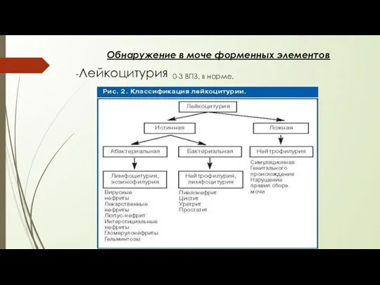 Обнаружение в моче форменных элементов -Лейкоцитурия 0-3 ВПЗ, в норме.