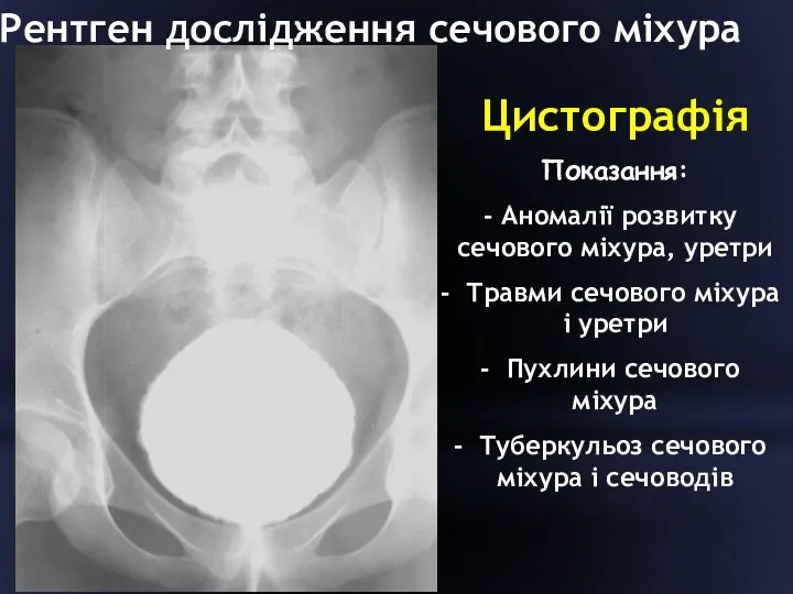 Цистографія Показання: Аномалії розвитку сечового міхура, уретри Травми сечового міхура