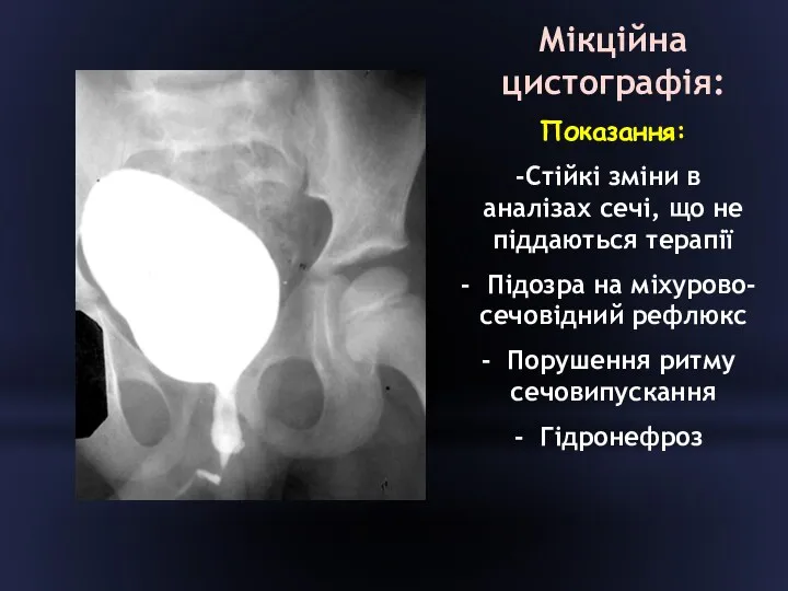 Мікційна цистографія: Показання: Стійкі зміни в аналізах сечі, що не