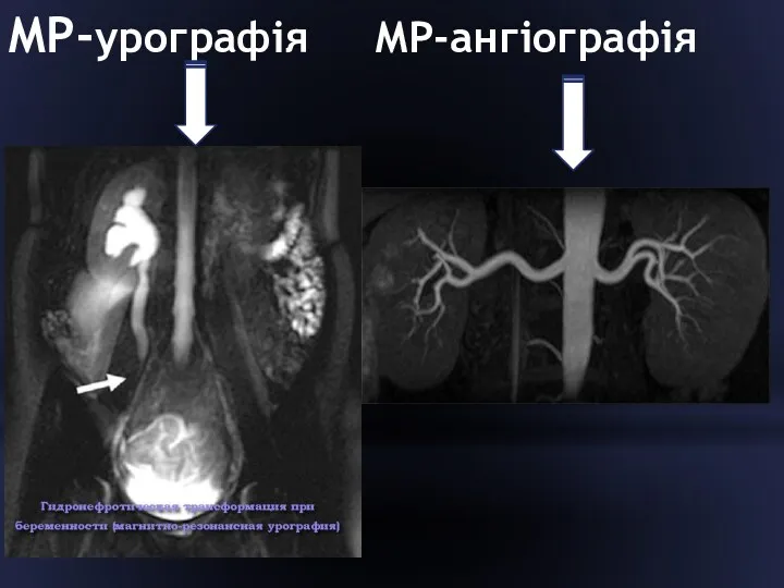 МР-урографія МР-ангіографія