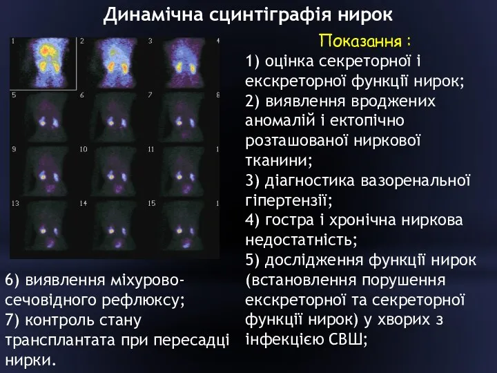 Динамічна сцинтіграфія нирок Показання : 1) оцінка секреторної і екскреторної