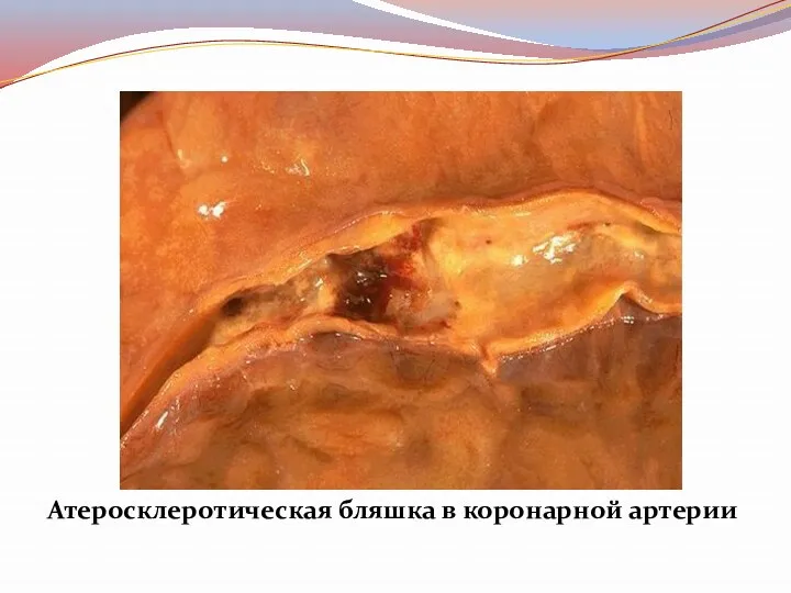 Атеросклеротическая бляшка в коронарной артерии
