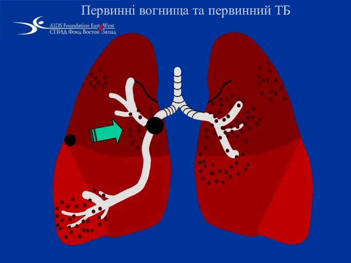 Первинні вогнища та первинний ТБ