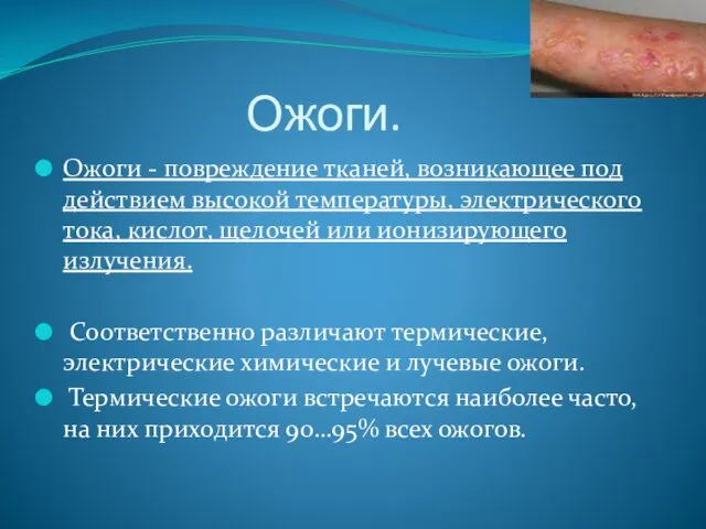 Ожоги. Ожоги - повреждение тканей, возникающее под действием высокой температуры,