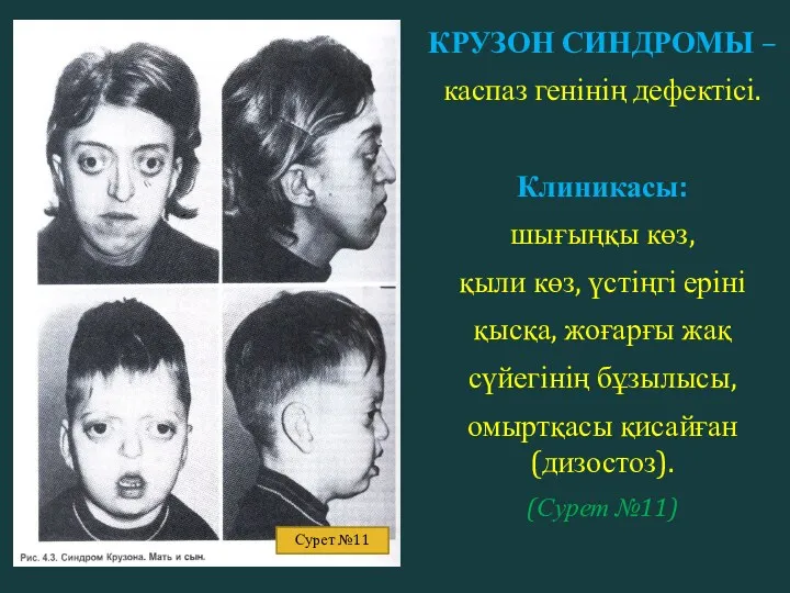 КРУЗОН СИНДРОМЫ – каспаз генінің дефектісі. Клиникасы: шығыңқы көз, қыли