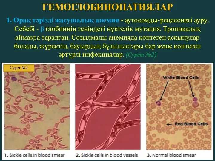 ГЕМОГЛОБИНОПАТИЯЛАР 1. Орақ тәрізді жасушалық анемия - аутосомды-рецессивті ауру. Себебі