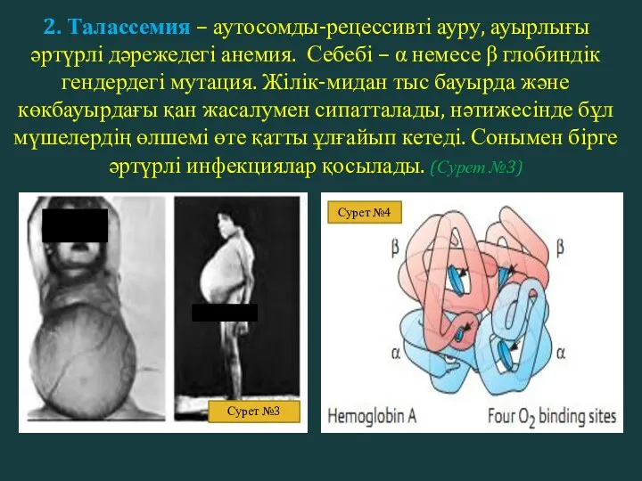 2. Талассемия – аутосомды-рецессивті ауру, ауырлығы әртүрлі дәрежедегі анемия. Себебі