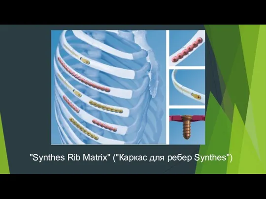 "Synthes Rib Matrix" ("Каркас для ребер Synthes")