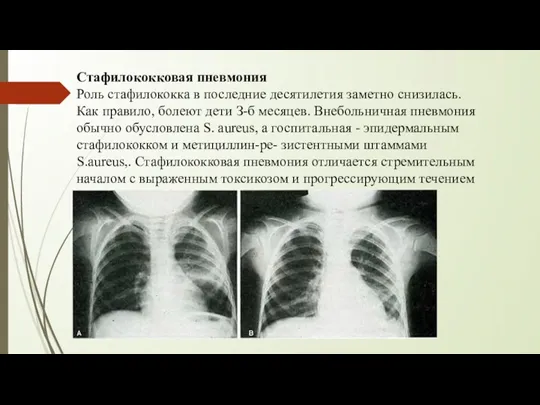 Стафилококковая пневмония Роль стафилококка в последние десятилетия заметно снизилась. Как