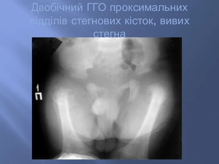 Двобічний ГГО проксимальних відділів стегнових кісток, вивих стегна