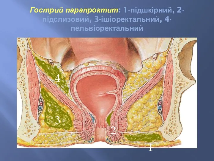 Гострий парапроктит: 1-підшкірний, 2-підслизовий, 3-ішіоректальний, 4-пельвіоректальний 1 2 3 4